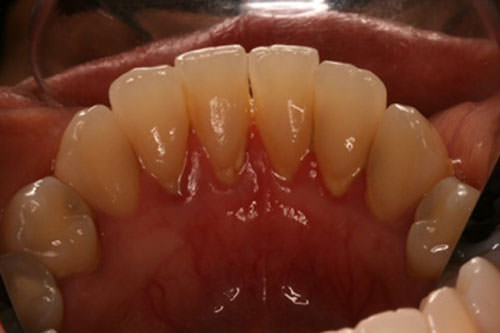 Fig. 4 Vista lingual de la zona post-inf-der. Además de presentar inflamación gingival moderada, se evidencia el abundante acúmulo de irritantes locales