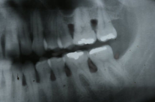 Fig. 5 detalle de radiografía panorámica donde se evidencia la perdida de soporte óseo