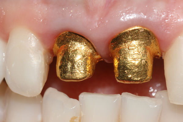 Figura 3 Prueba clínica de las estructuras obtenidas por electrodeposición en oro.