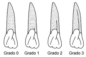 Figura 1 Surco interrumpido. Adaptado de S. Hillson (20).