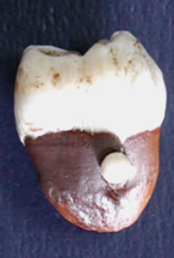 Figura 4 Perla de esmalte