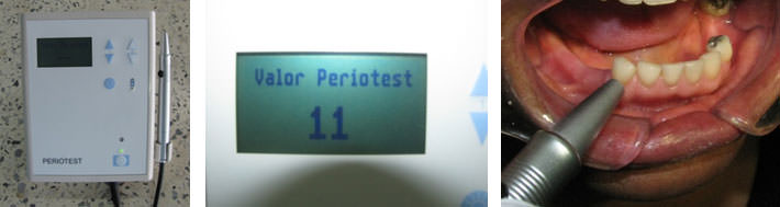 Fig. 1 Durante el proceso de medición el instrumento Periotest debe ser siempre mantenido perpendicular al eje largo del diente. Una señal audible de la computadora indica desviaciones inaceptables. El punto de impacto, es decir, el punto de medida es el centro de la corona clínica. El paciente debe estar sentado en posición erguida con ausencia de contactos entre los dientes de los maxilares superior e inferior.