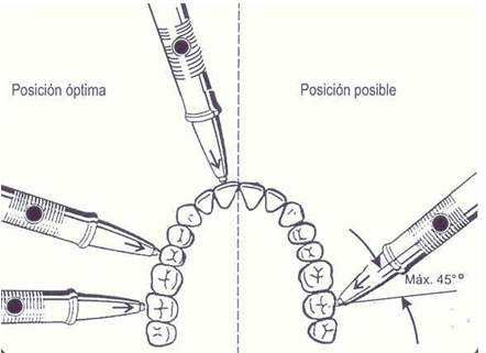 Fig. 2 La medición VPT debe realizarse en dirección medio-bucal, dirigido en ángulo recto al centro del objeto de la medición, diente o implante. El ángulo de impacto no puede desviarse más de 45º.