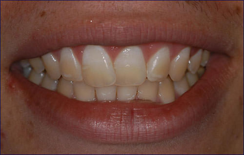 Figura 1 Foto inicial de la sonrisa del paciente. Se observa las pigmentaciones en las regiones incisales de los dientes.