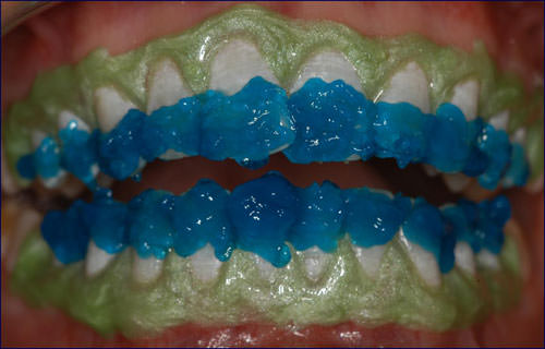 Figura 2 Después de la aplicación de la barrera gingival fotopolimerizable y acondicionamiento con ácido fosfórico 37%, por 15 segundos de los tercios incisales con mayor número de pigmentaciones.