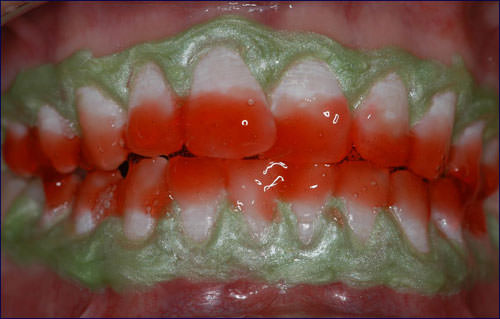 Figura 5 Aplicación localizada del agente blanqueador en el tercio medio e incisal de las caras vestibulares.