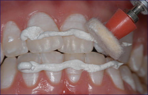 Figura 6 Pulido de los dientes con disco de fieltro y pasta para pulido.