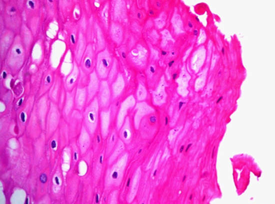 Fig 1 Aspecto histopatológico de Leucoplasia Vellosa Bucal. Hematoxilina y Eosina. Magn original: X 40