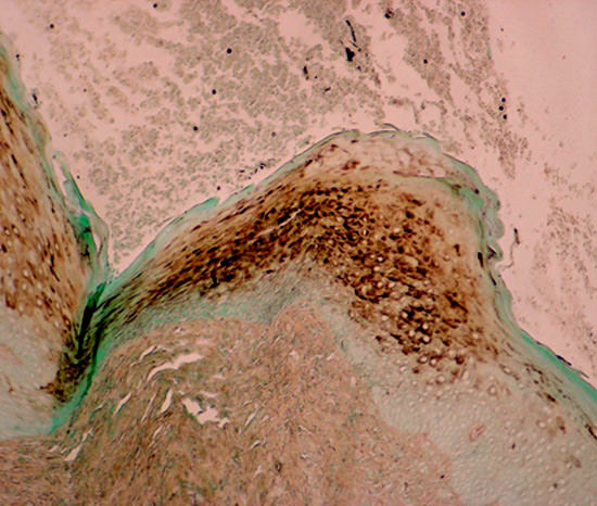 Fig 2 Imagen de LVO con coloración especial de Grocott Magn Orign X20. La imagen muestra hifas de Candida albicans en el epitelio de la muestra de Leucoplasia vellosa Bucal