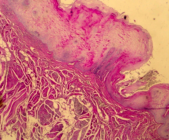 Fig 3 Detección de Candida albicans mediante coloración especial de PAS. Magn Orign X 20.