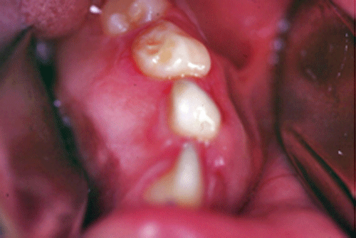 Figura 3. Aspecto clínico intrabucal de la lesión