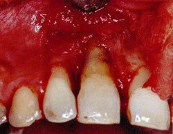 Sellado de la resorción radicular con vidrio ionomérico (Vitremer)®