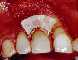 5b: Colocación de membrana angosta para dientes anteriores de la casa Gore Tex®.