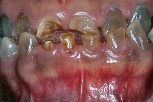 Fig. Nº 2: Vista intrabucal frontal del paciente con D.I. presentación inicial