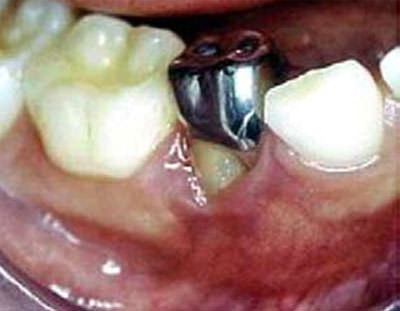 Figura Nº 5 Obtenida de http://odontologia.univalle.edu.co/revista/publicaciones/13-01-2005/pdf/06V13N01-05.pdf