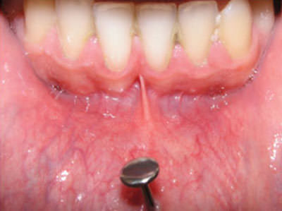 Figura Nº 6 Obtenida de Escudero Castano, N y Bascones Martinez, A. Posibles alteraciones locales y sistémicas de los piercings orales y periorales. Av Odontoestomatol. Vol. 23, Nº 1..