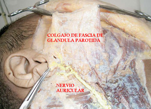 Figura 2 Operación modificada, el colgajo de fascia de glándula parótida fue formado (Tomado Ya Zumeng y cols11)