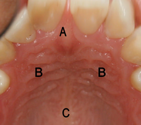 Fig. 1 En que se detallan las rugosidades o rugas palatinas justo por detrás de los dientes anterosuperiores. A: Papila Incisiva. B: Rugas Palatinas. C: Rafe Médio.