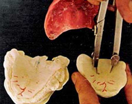 Fig. 2 Comparación entre los modelos obtenidos de la impresión mucosa de un cadáver y de la impresión de la superficie mucosa de la prótesis.