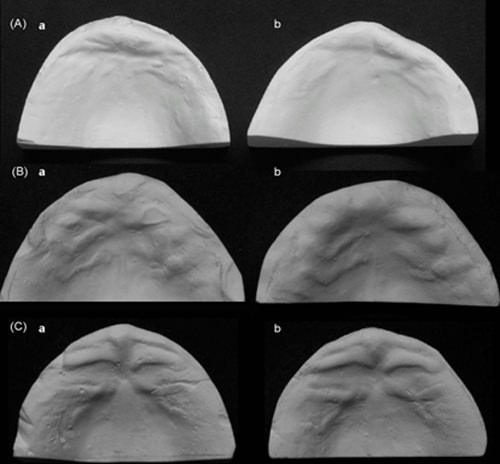 Fig. 4 Casos que dificultan la rugoscopia. A: Rugas pobremente marcadas. B: Cambios en la prominencia. C: Patrón muy simple.