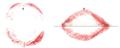 Fig. 6 A la izquierda se ve una impresión labial con la boca abierta y a la derecha la impresión de la misma boca pero sobre un papel doblado a la mitad. Obsérvese que las comisuras son de tipo horizontal. Nótese también la ubicación del tubérculo lingual (T) en ambos casos.