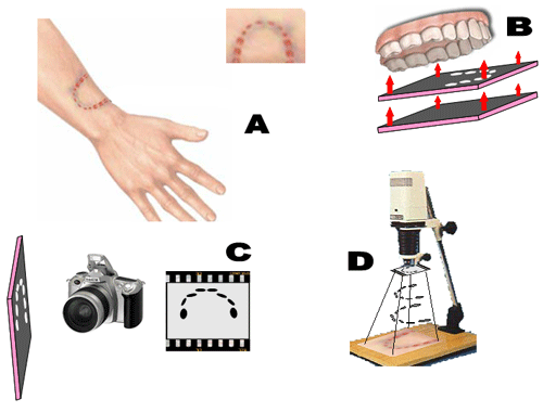Fig. 7 Procesos para la oclusografía: A: Registro fotográfico de la lesión sobre la víctima con relación a tamaño real 1:1. B: Obtención del oclusograma con una lámina de cera rosada que se ha teñido de negro con grafito. Esto se realiza con todos los sospechosos. C: Foto en blanco y negro de los oclusogramas y revelado del negativo. D: Colocación de los negativos en la parte superior de una ampliadora fotográfica (en el espacio diseñado para tal fin) y proyección sobre la foto (A) hasta ver coincidencia. La coincidencia de uno de los negativos corresponderá al causante de la lesión.