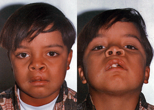 Fig. 5 y Fig. 6 El postoperatorio de 15 días muestra el labio con buena conformación anatómica y las alas nasales simétricas.
