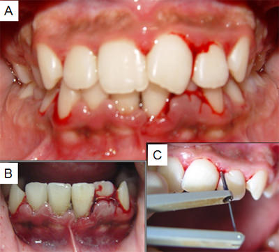 Fig. 1: 1A- Inicio del caso clínico; 1B- Detalle de la región anterior inferior mostrando intensa inflamación gingival y sangramiento; 1C- Sondaje computarizada.