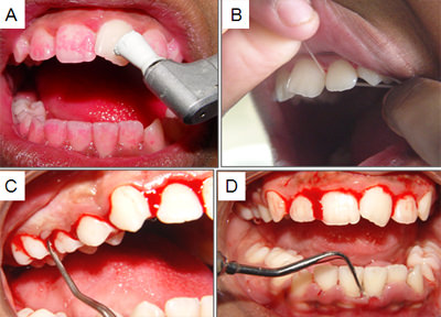 Fig. 2: 2A- Coloración de la placa bacteriana y profilaxis dental; 2B- Instrucción de higiene y uso del hilo dental; 2C- Remoción del cálculo dental con ultra-sonido; 2D- Remoción del cálculo dental con curetas.