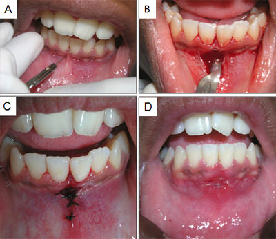 Fig. 3: 3A- Frenectomía labial inferior; 3B- Incisión y remoción de las fibras; 3C- Sutura; 3D- Post-operatorio después de 1 semana.