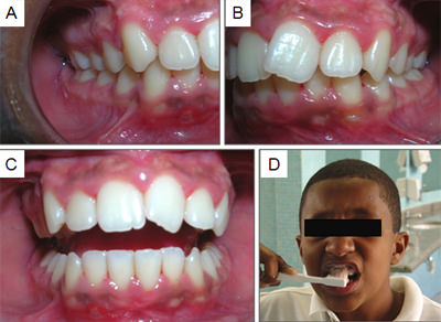 Fig. 4: 4A- Final del caso clínico, vista lateral derecha; 4B- Vista lateral izquierda; 4C- Vista anterior; 4D- Sesión de control, paciente consciente, técnica de higiene bucal correcta.