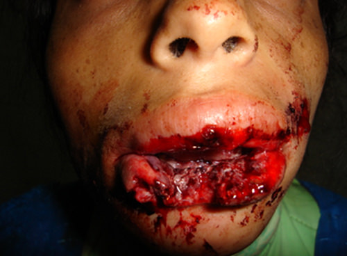 Figura 1 Orificio de salida con destrucción del labio inferior