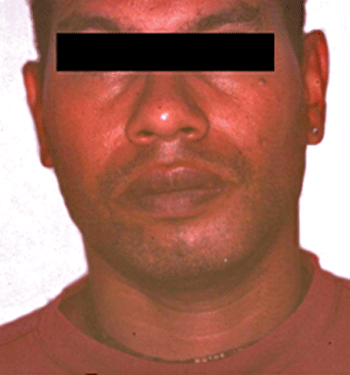 Figura 1. Aspecto clínico extrabucal