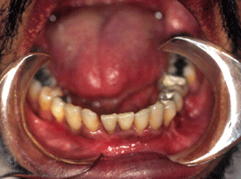 Figura 3. Aspecto clínico intrabucal