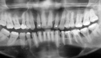 Figura 5. Aspecto radiográfico posterior a la Endodoncia