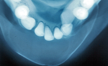 Figura 3 Radiografía oclusal