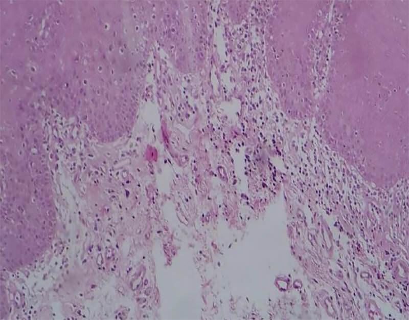 Figura 4. Microfotografía (H&E a 40X) que muestra moderado infiltrado inflamatorio crónico subepitelial.
