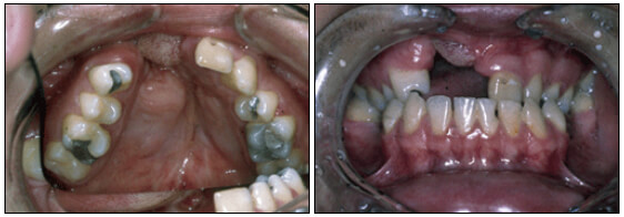 Foto Nº3 y 4 Ausencia de los siguientes dientes: 16,13,12,11,22,24,35,36,37,45,46 y 47. Arcada constreñida.