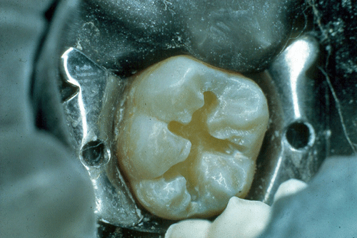 Figura 3. Cavidad oclusal estrecha sin caries en dentina. Bajo los conceptos actuales se consideran para su restauración una resina compuesta y un sellante de puntos y fisuras
