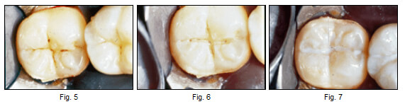 Figuras 5, 6 y 7 Lesiones cariosas en un paciente de alto riesgo. Se utilizó una fresa redonda de 1/8 para abrir la fisura y examinar la extensión de la caries. Se obturó con un sellante de puntos y fisuras