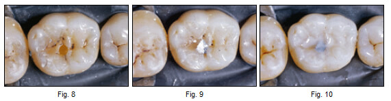 Figuras 8, 9 y 10 Eliminación de caries en la fosa central, la cual se restauró con amalgama. Aplicando un concepto actual de extensión por prevención en el resto de la fisura se utilizó un sellante de puntos y fisuras.
