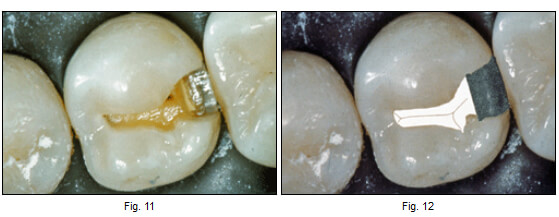 Figuras 10 y 11 Cavidad de la Clase II en un premolar realizada con los conceptos tradicionales de extensión por prevención. La figura 12 es una imagen generada por computador que indica la forma de tratamiento actual: una cavidad próximal única y sellante de puntos y fisuras en oclusal.