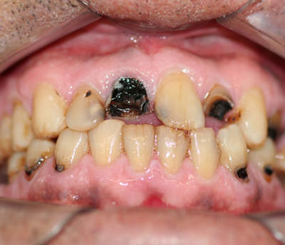 Figura 1 Condiciones bucales antes del inicio de la radioterapia de uno de los casos evaluados. En algunos dientes se observa caries radicular.