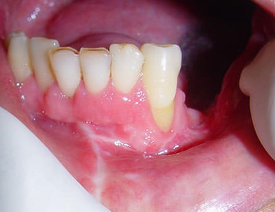 Figura 2 Pérdida de inserción periodontal el diente 34 después resecado de parte del cuerpo de la mandíbula adyacente al mismo, factor que llevo a indicar de exodoncia.