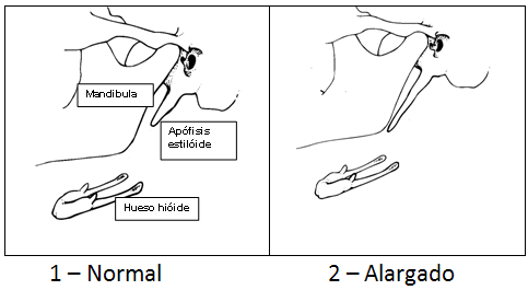 Figura 1 Esquema de la clasificación de la apófisis estiloide12 - adaptado por la autora de este estudio.