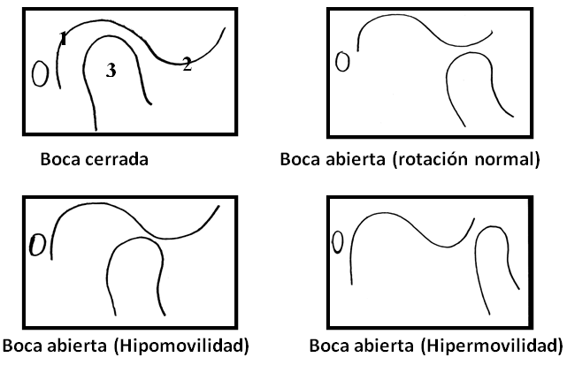 Figura 2 Clasificación esquemática para el análisis funcional del cóndilo mandibular en relación a la eminencia articular - apertura bucal máxima - Legenda: 1 - Fosa articular del hueso temporal, 2 - Eminencia articular del hueso temporal, 3 - Cóndilo mandibular