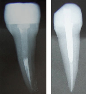 Fig. 1 Radiografías de control de adaptación y cementado.