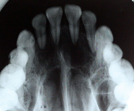 Fig. 2 Radiografía oclusal superior