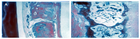 Figura 2: Corte histológico de un área interproximal de un primer y segundo molar maxilar. A: grupo control; B: grupo experimental tratado con cortisona. Note la diferencia en la densidad ósea, al igual que el escaso trabeculado y gran número de osteoclastos en sus lagunas reabsortivas en el grupo experimental. Tomado de: Ashcraft y col., 1992.