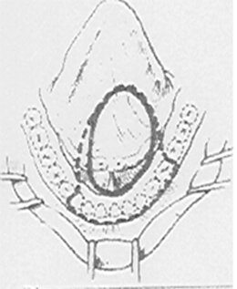 Diagrama 1B Ubicación de la lesión cercana al conducto submandibular.